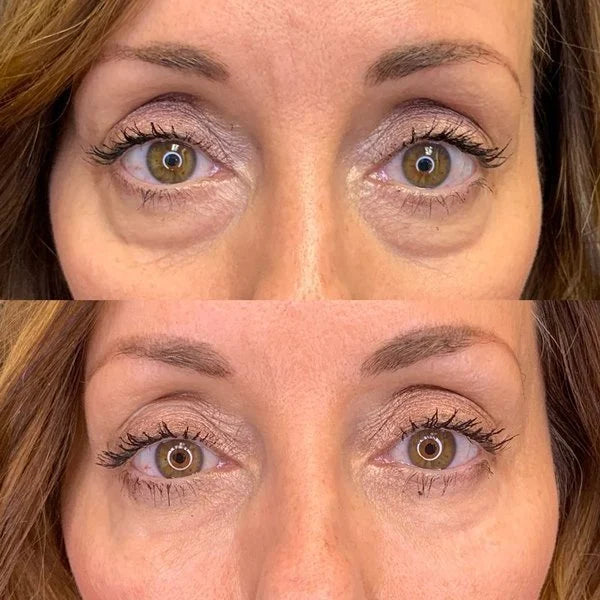 EyeZen™ - Anti-Falten Augencreme (1+1 GRATIS)